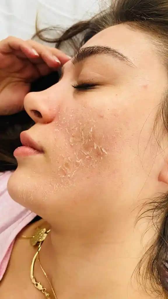 Yosun Peeling Nedir ve Cilt Sağlığını Artıran Doğal Bir Yöntem