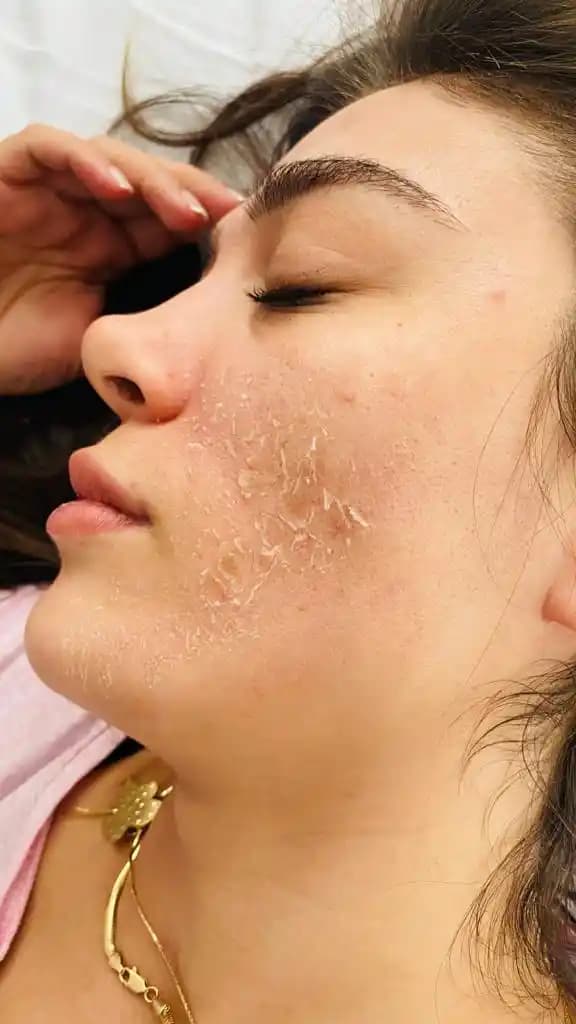 Yosun Peeling Nedir ve Cilt Sağlığını Artıran Doğal Bir Yöntem