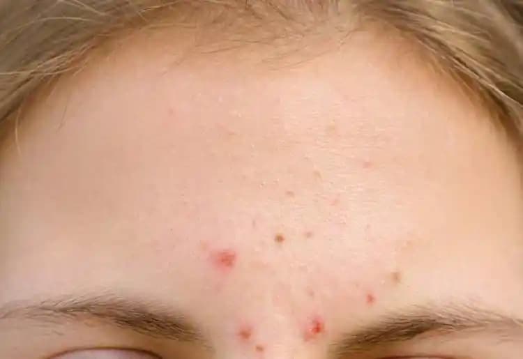 Yüz Kenarında Çıkan Sivilceler: Nedenleri, Tedavi Yöntemleri ve Bakım İpuçları