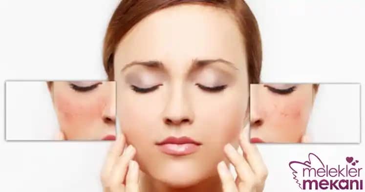Yüz Kızarması Nasıl Geçer: Nedenleri, Çözümler ve Günlük Önlemler