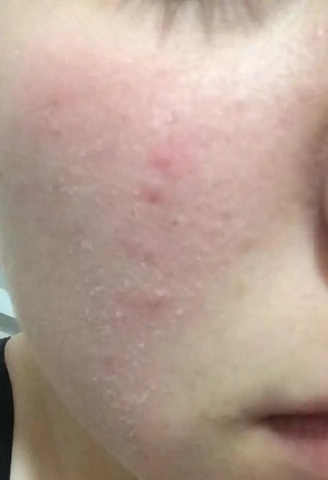 Yüz Kuruluğu Nedenleri ve Çözüm Yolları Hakkında Kapsamlı Rehber