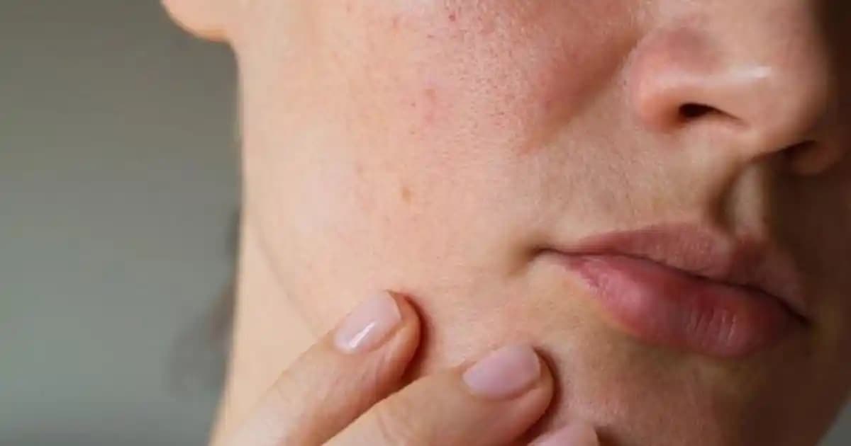 Yüz Tahrişi Nedenleri ve Doğru Bakım Yöntemleri Hakkında Bilgiler