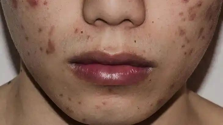 Yüz Yaralarının İyileşme Süreci ve Hızlandırıcı Yöntemler Hakkında Kapsamlı Bilgi