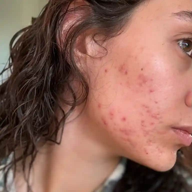 Yüzde Alerji Benzeri Sivilcelerin Nedenleri Belirtileri ve Etkili Tedavi Yöntemleri