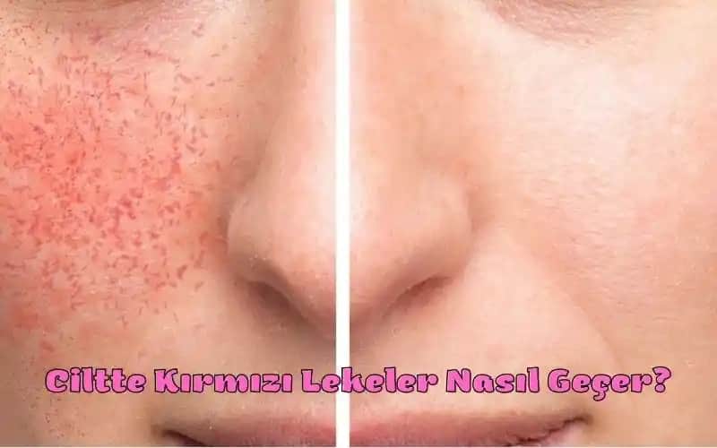 Yüzde Aniden Çıkan Kırmızı Lekelerin Nedenleri ve Çözüm Yolları Hakkında Detaylı Bilgi