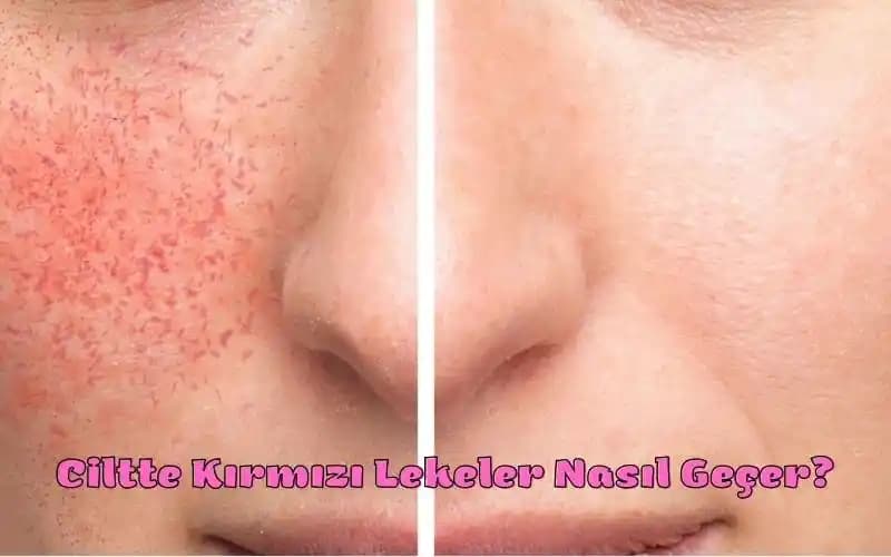 Yüzde Aniden Çıkan Kırmızı Lekelerin Nedenleri ve Çözüm Yolları Hakkında Detaylı Bilgi