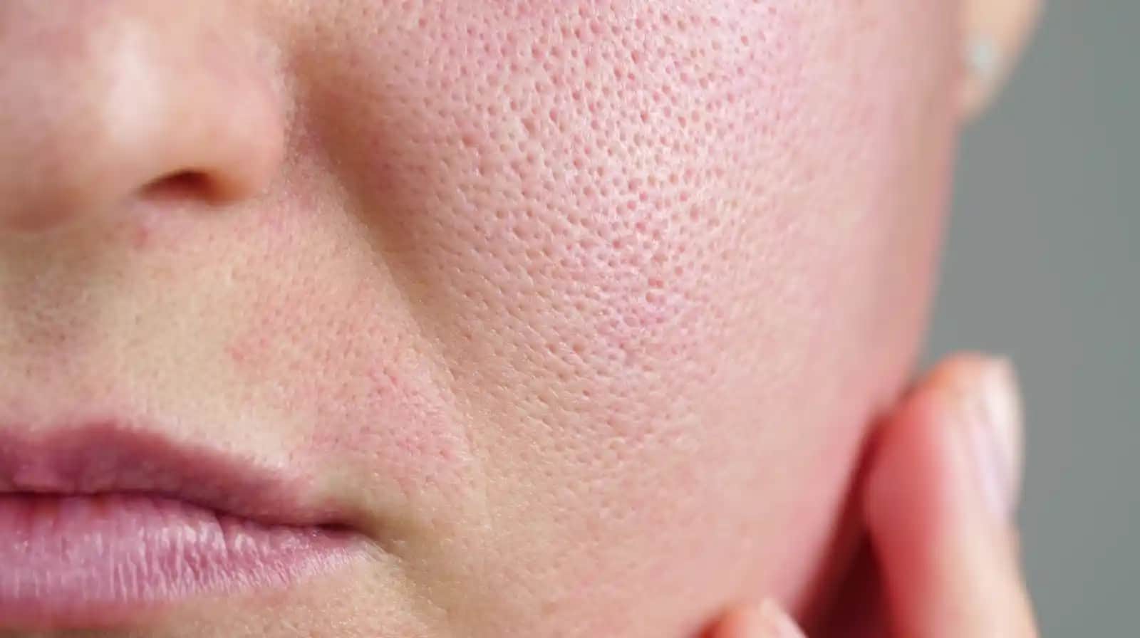 Yüzde Aşırı Yağlanma Sorunu ve Etkili Bakım Yöntemleri