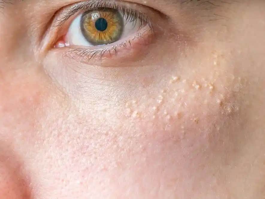 Yüzde Beyaz Kabarcıklar Nedenleri Belirtileri ve Çözüm Yolları