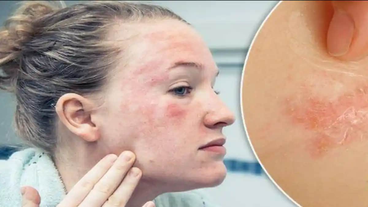 Yüzde Çıkan Egzama Nedenleri, Belirtileri ve Kozmetik Ürünlerle Yönetimi