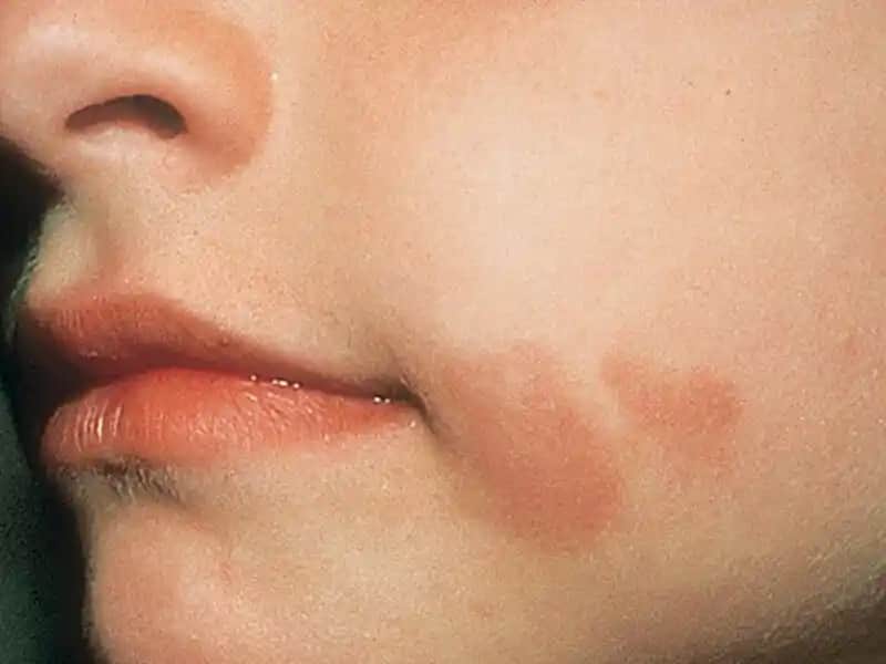 Yüzde Çıkan Lekelerin Nedenleri ve Etkili Çözüm Yöntemleri Hakkında Bilmeniz Gerekenler