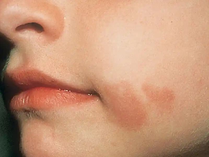 Yüzde Çıkan Lekelerin Nedenleri ve Etkili Çözüm Yöntemleri Hakkında Bilmeniz Gerekenler