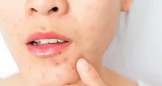 Yüzde Çıkan Sivilceler: Nedenleri ve Etkili Tedavi Yöntemleri