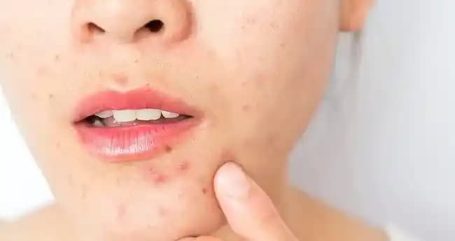 Yüzde Çıkan Sivilceler: Nedenleri ve Etkili Tedavi Yöntemleri