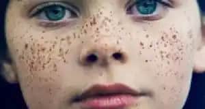 Yüzde Çil Nedenleri ve Cilt Sağlığına Etkileri Gelişmiş Bilgi Rehberi