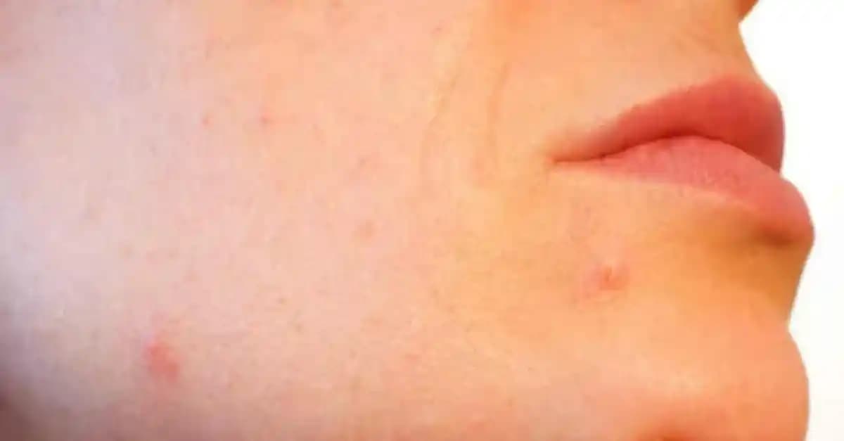 Yüzde Deri Altı Sivilceleri: Nedenleri, Tedavi Yöntemleri ve Kozmetik Yaklaşımlar