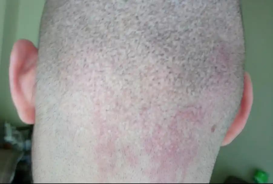 Yüzde Geçmeyen Kızarıklıkların Nedenleri ve Etkili Çözüm Yöntemleri