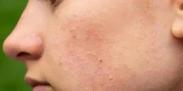 Yüzde Isilik Benzeri Sivilceler: Nedenleri ve Etkili Çözüm Yöntemleri