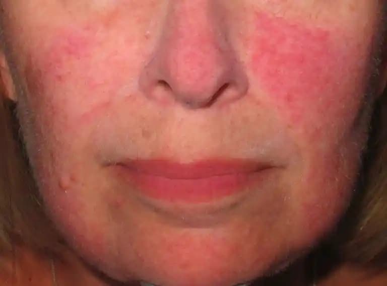 Yüzde Kırmızı Leke Nedenleri, Çözümleri ve Cilt Bakımında Dikkat Edilmesi Gerekenler