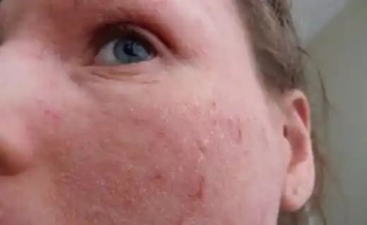 Yüzde Kızarıklık ve Kaşıntı Problemleri: Kozmetik Ürünlerle İlişkili Nedenler ve Çözüm Yolları