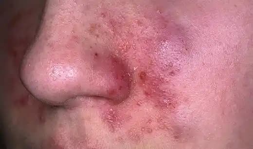 Yüzde Kızarıklık ve Pullanmanın Nedenleri ile Etkili Cilt Bakımı Yöntemleri