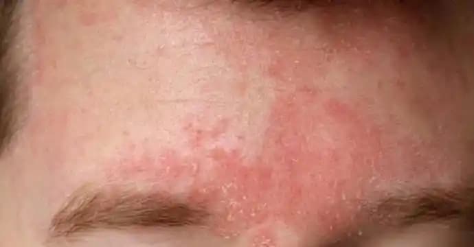 Yüzde Kuru Egzama: Belirtiler, Nedenler ve Doğru Bakım Yöntemleri