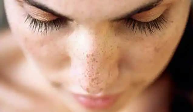 Yüzde Leke Hastalığı Nedenleri ve Etkili Tedavi Yöntemleri