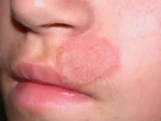 Yüzde Mantarı ve Sivilce Arasındaki Bağlantı: Belirtiler, Tanı ve Tedavi Yöntemleri