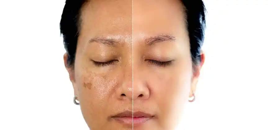 Yüzde Oluşan Lekelerin Nedenleri, Çözümleri ve Koruma Yöntemleri