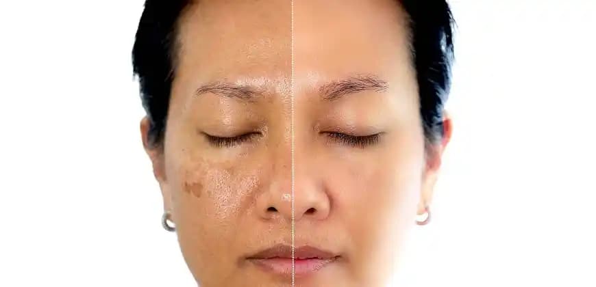 Yüzde Oluşan Lekelerin Nedenleri, Çözümleri ve Koruma Yöntemleri