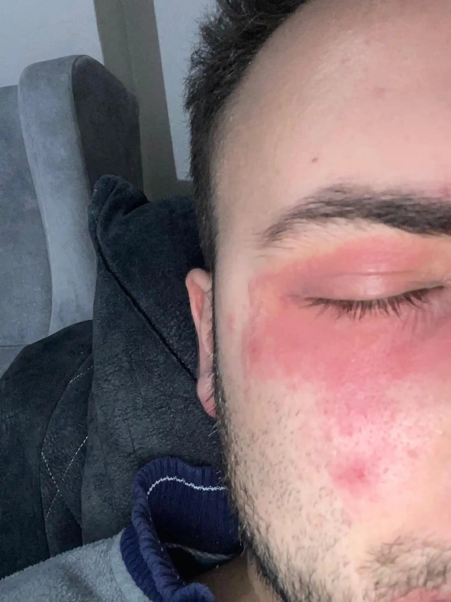 Yüzde Pütürlü Kızarıklık Nedenleri, Belirtileri ve Etkili Çözüm Yolları