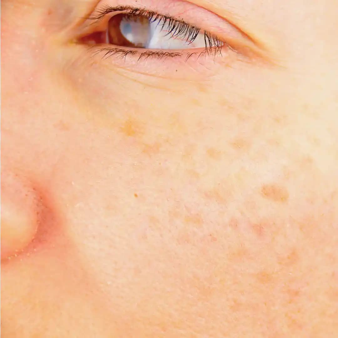 Yüzde Sarı Leke Nedir, Nedenleri ve Kozmetik Tedavi Seçenekleri Hakkında Bilgi