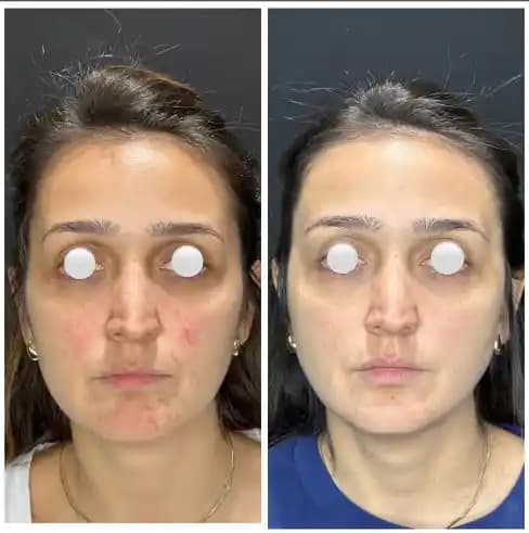 Yüzde Sivilce Benzeri Kabarıklıkların Nedenleri ve Etkili Tedavi Yöntemleri