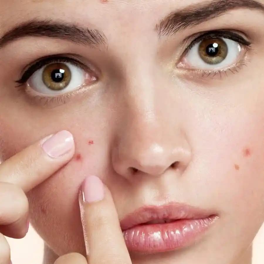 Yüzde Sivilce Nedenleri, Faktörleri ve Etkili Çözüm Yöntemleri Hakkında Kapsamlı Bilgi