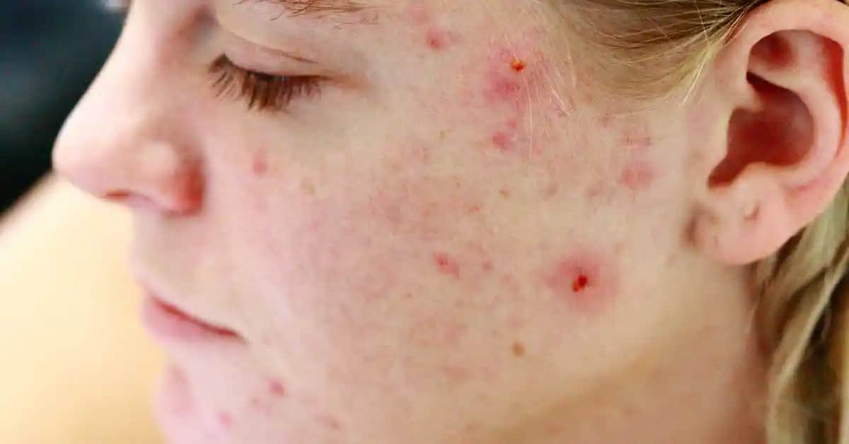 Yüzde Sivilce Nedenleri ve Doğal Çözüm Yöntemleri Hakkında Kapsamlı Bilgi