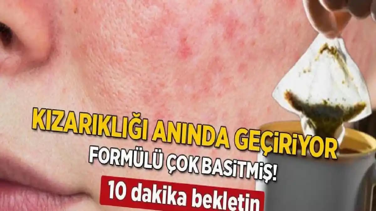 Yüzde Sivilce ve Kızarıklık Problemleri İçin Güncel Kozmetik Bakım Yaklaşımları
