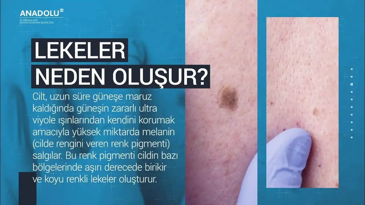 Yüzde Siyah Lekelerin Nedenleri ve Etkili Tedavi Yöntemleri Hakkında Kapsamlı Rehber