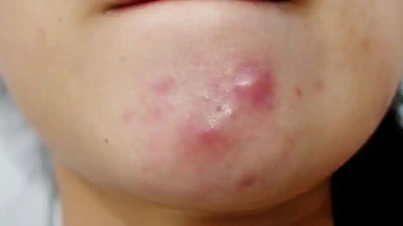 Yüzde Ucu Olmayan Sivilceler: Nedenleri, Çözümleri ve Kozmetik İpuçları