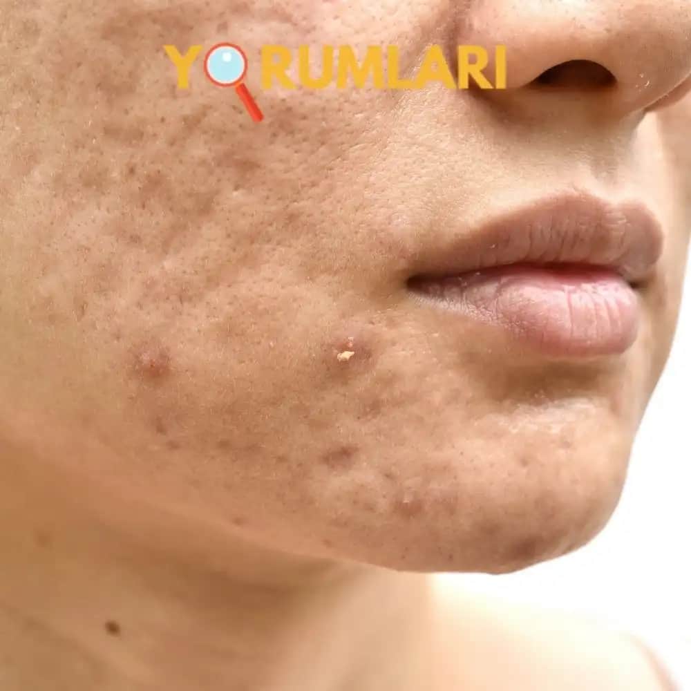 Yüzdeki Akne Nedenleri ve Doğru Bakım Yöntemleri Hakkında Kapsamlı Rehber