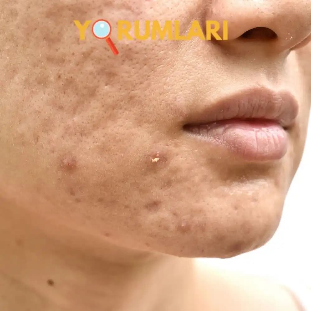 Yüzdeki Akne Nedenleri ve Doğru Bakım Yöntemleri Hakkında Kapsamlı Rehber