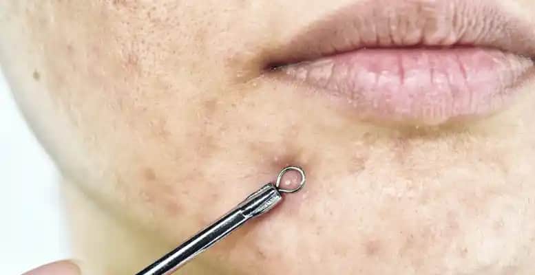 Yüzdeki Beyaz Noktalar Neden Olur ve Kalıcı Çözüm Yöntemleri Nelerdir