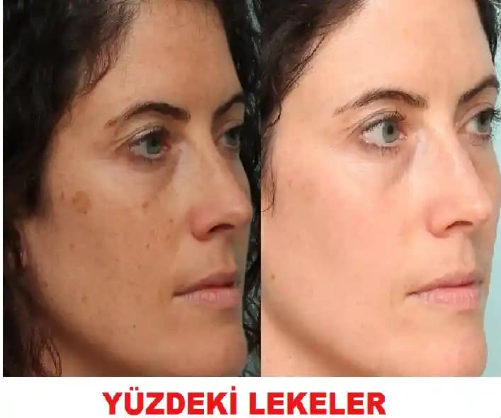 Yüzdeki Cilt Lekeleri: Nedenleri, Tedavi Yöntemleri ve Korunma Tavsiyeleri