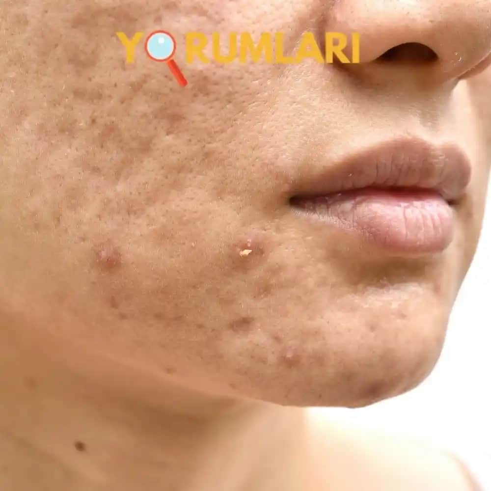Yüzdeki Çukurlara Karşı Etkili Serumsuz Çözüm Yöntemleri ve Doğru Ürün Seçimi