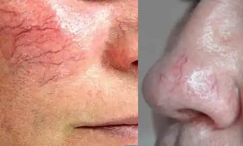 Yüzdeki Damarların Belirgin Olması Nedenleri ve Etkili Estetik Çözüm Yöntemleri