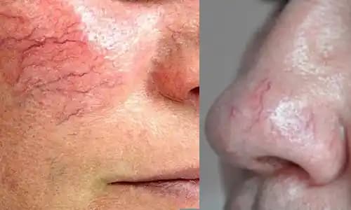 Yüzdeki Damarların Belirgin Olması Nedenleri ve Etkili Estetik Çözüm Yöntemleri