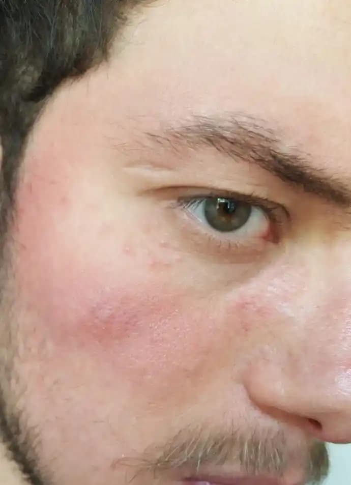 Yüzdeki Deri Dökülmesini Önleme ve Tedavi Yöntemleri Hakkında Kapsamlı Rehber