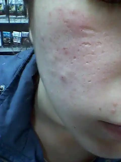 Yüzdeki Gözenekleri Kapatmak İçin Etkili ve Güvenilir Yöntemler Rehberi