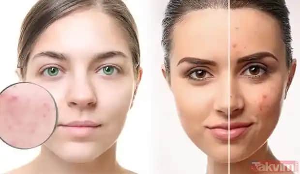 Yüzdeki İltihaplı Sivilceler Nasıl Geçer ve Etkili Tedavi Yöntemleri