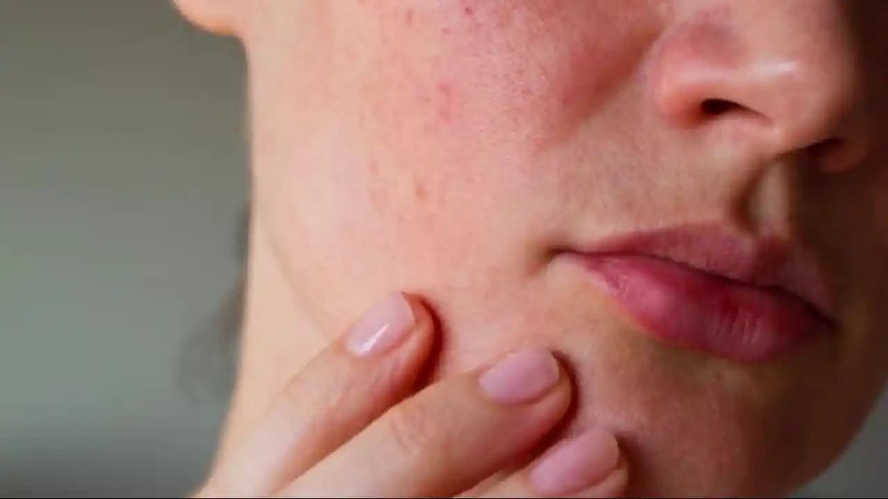 Yüzdeki Kabarcıkların Nedenleri ve Cilt Sağlığını Koruma Yöntemleri