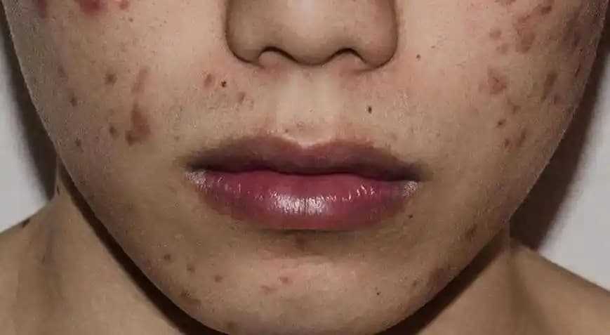 Yüzdeki Kabuklu Yara Nasıl Geçer: Etkili Doğal ve Tıbbi Çözümler Rehberi