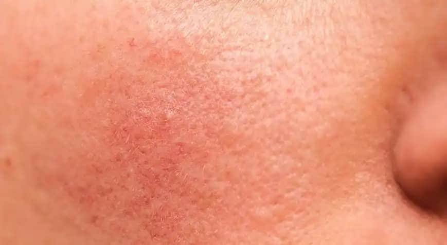 Yüzdeki Kaşıntı ve Kızarıklık Nasıl Giderilir Cilt Bakımı ve Doğal Çözümler